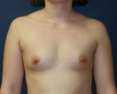 Feel Beautiful - Breast Implants San Diego 62a - Before Photo